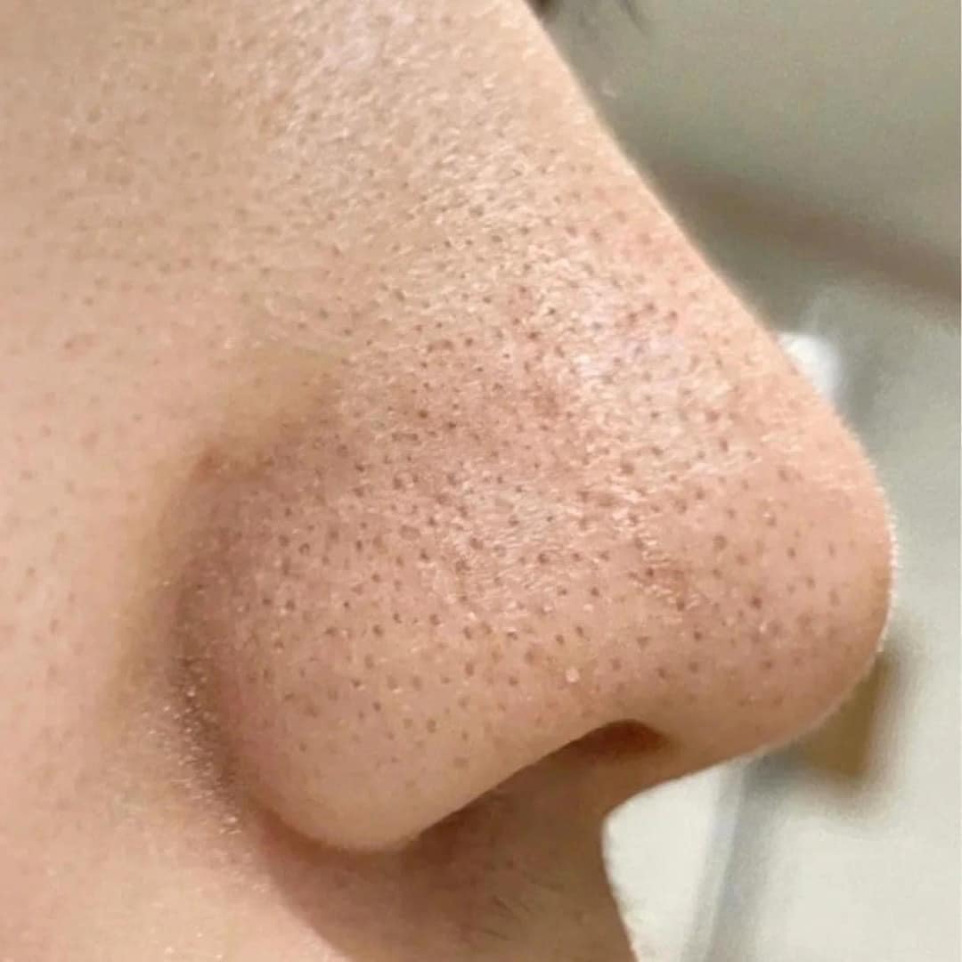Nakiz Lively Nose Premium Blackhead Remover – 15 g