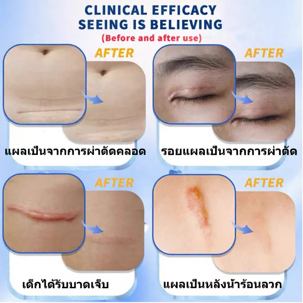 Dermatix Ultra Silicone Scar Reduction Gel – 15 g | Suvaree Sydney