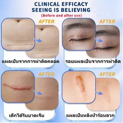 Dermatix Ultra Silicone Scar Reduction Gel – 15 g | Suvaree Sydney